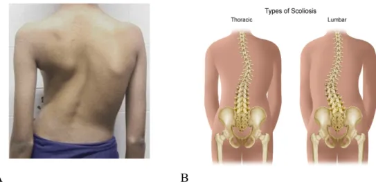 Gambar . A.Gambaran skoliosis, B. proyeksi tulan vertebrae pada skoliosis torakalis  dan lumbalis