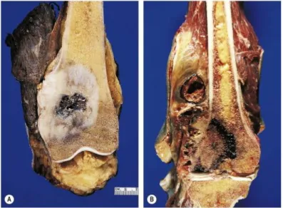 Gambar 2.6. A&amp;B, Makroskopis dari osteosarkoma pada tulang paha. Tampak  pada daerah metafisis yang khas