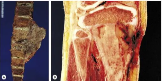 Gambar 2.7. A&amp;B, Gambaran makroskopis lain dari osteosarkoma. (A0 Tumor  ekstensif melibatkan tulang belakang dan menghasilkan massa jaringan lunak  yang besar