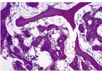 Gambar 2.8.  Osteosarkoma. Tulang yang malignant lebih basofilik dan memiliki  pinggir yang irregular daripada trabekula tulang normal