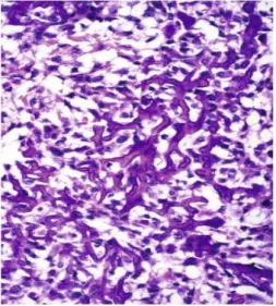 Gambar 2.10.  Gambaran mikroskopis osteosarkoma yang menunjukkan  karekteristik trabekula tipis  yang basofilik dengan gambaran yang mirip seperti 
