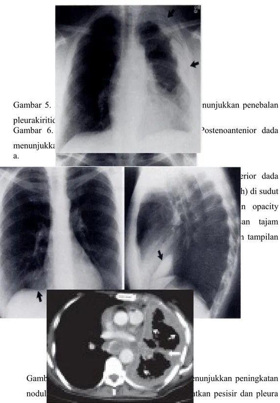 Gambar   4.   Diffuse   malignant   pleural   mesothelioma.  Radiografi Posteroanterior  dada  menunjukkan  difus  melingkar  nodular  penebalan pleura  (panah),  dengan   ekstensi  ke  pleura  mediastinal  dan   celah, membungkus paru kanan