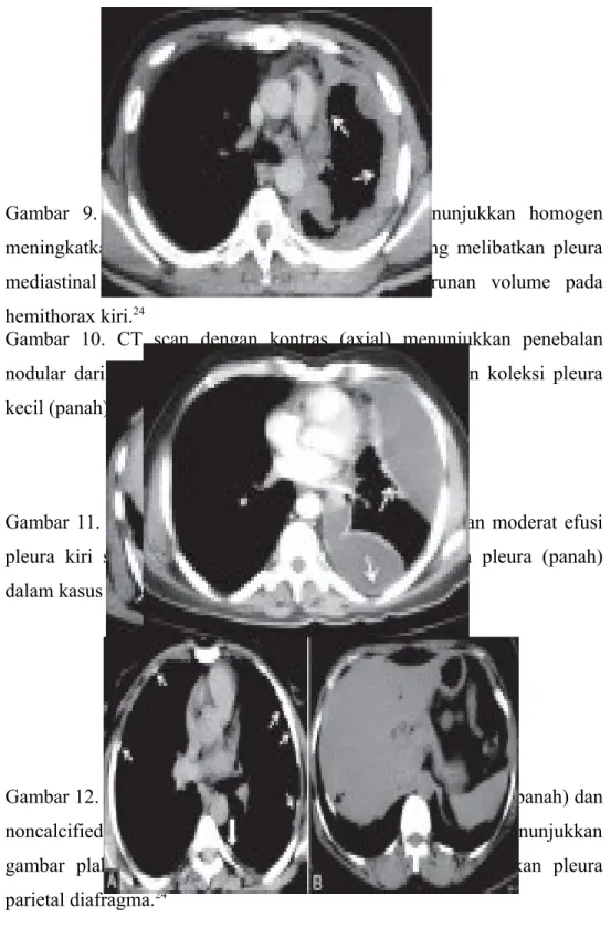 Gambar   9.   CT   scan   dengan   kontras   (axial)   menunjukkan   homogen meningkatkan nodular penebalan pleura (panah) yang melibatkan pleura mediastinal   dan   pesisir   dengan   perubahan   penurunan   volume   pada hemithorax kiri