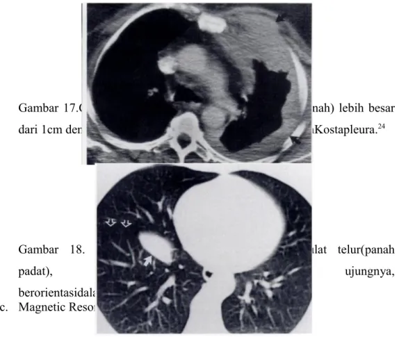Gambar 17.CT scanmenunjukkanpenebalanpleuradifus(panah)  lebih besar dari 1cm dengan ketebalan, melibatkankirimediastinumdanKostapleura
