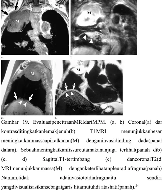 Gambar   19.   EvaluasipencitraanMRIdariMPM.  (a,  b)  Coronal(a)  dan kontrasditingkatkanlemakjenuh(b)  T1MRI  menunjukkanbesar, meningkatkanmassaapikalkanan(M)  denganinvasidinding   dada(panah dalam)