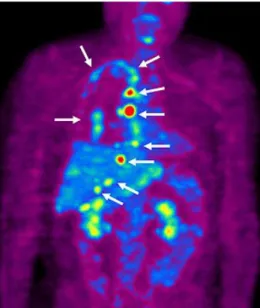 Gambar  20.GambarproyeksianteriorscanFDG-PET  menunjukkanbeberapa fokusserapantracerabnormal  yangmenguraikanpermukaanpleuraparu-parukanan