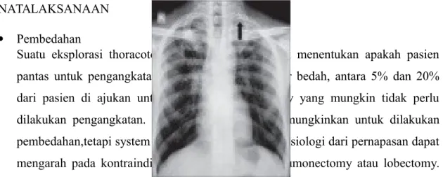 Gambar   24.   Rontgen   dada   menunjukkan   penebalan   pleura   apikal   (panah)   di   wilayah apikal kiri.