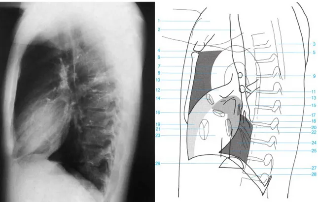 Gambar 6 dan 7: Gambar Radiograph Dada Lateral  5