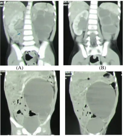 Gambar 5. Hasil CT scan abdomen anak laki-laki usia 5 tahun dengan kecurigaan  massa intraabdomen