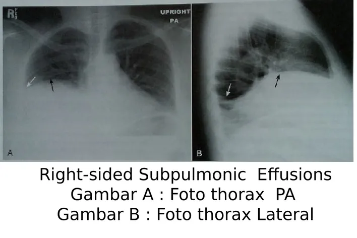 Gambar B : Foto thorax Lateral