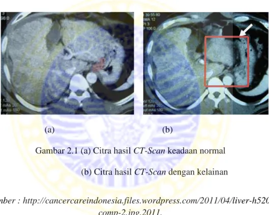 Gambar 2.1 (a) Citra hasil CT-Scan keadaan normal   (b) Citra hasil CT-Scan dengan kelainan 