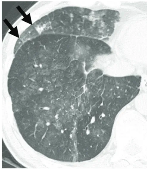 Gambar 13  Gambaran roentgen toraks pasien dengan  beriliosis: Tampak pembesaran limfonodus hilus 13
