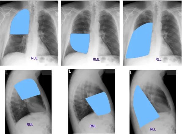 Gambar 11. Radioanatomi lobus paru kanan radiografi toraks PA dan lateral 
