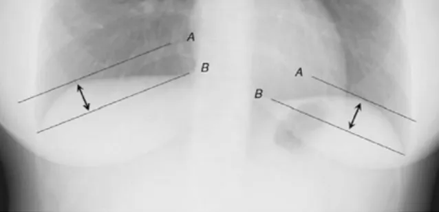 Gambar 1. Diafragma pada foto toraks PA. Cara menilai tinggi kubah diafragma. 