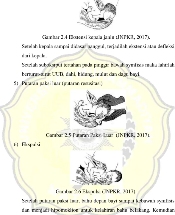 Gambar 2.4 Ekstensi kepala janin (JNPKR, 2017). 