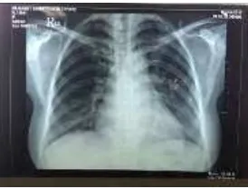 Gambar 2. Foto rontgen dada penderita pada hari pertama MRS (15/10/2015) 