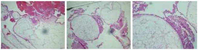 Gambar 5. Hasil histopatologi mola-endometrium 