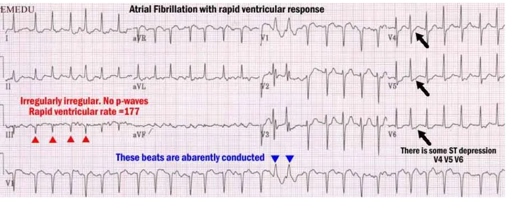 Gambar 1 : EKG AF RVR 