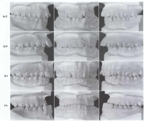 Gambar 3. Dental cast atau model gigi 
