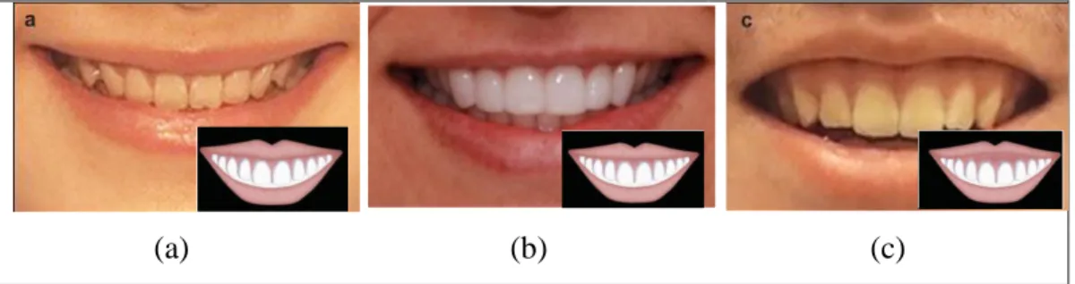 Gambar  3.  Kurvatura  bibir  atas  yang  (a)  :  melengkung  ke  atas  ,  (b)  :  lurus,   (c) melengkung ke bawah