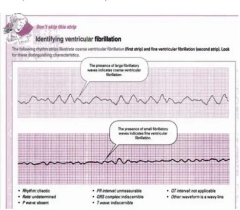 Gambar 7.  Interpretasi EKG pada Ventrikel Fibrilasi  Sumber : Wilkins LW  25