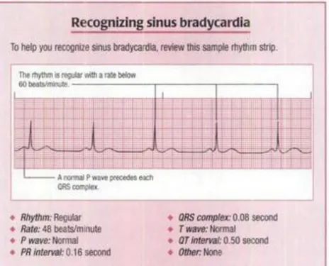 Gambar 9. Interpretasi EKG pada Sinus Bradikardi   Sumber : Wilkins LW  30