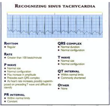 Gambar 2. Interpretasi EKG pada Sinus Takikardi   Sumber : Kowalak, Jennifer Lynn  13