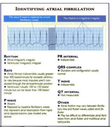 Gambar 3.  Interpretasi EKG pada Atrial Fibrilasi   Sumber : Kowalak, Jennifer Lynn  16
