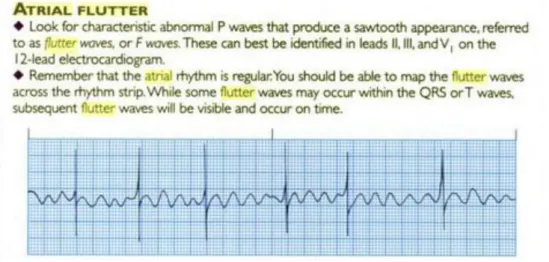 Gambar 4. Interpretasi EKG pada Atrial Flutter   Sumber : Kowalak, Jennifer Lynn  18