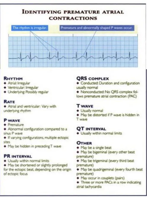 Gambar 5. Interpretasi EKG pada Atrial Ekstrasistol    Sumber : Kowalak, Jennifer Lynn  20