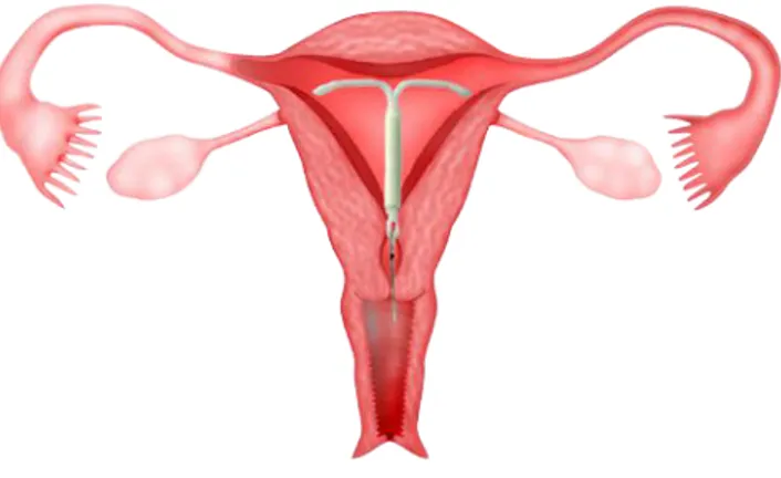 Gambar 3.9 Perangkat kontrasepsi intrauterin Mirena®