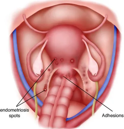 Gambar 3.1 Endometriosis pada uterus dan ligamen uterosakral  dengan adhesi kolon sigmoid ke uterus