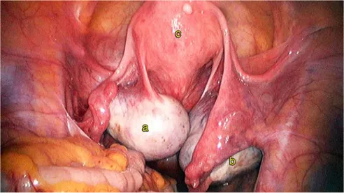 Gambar 3.5 Endometrioma bilateral (a) endometrioma  kiri, (b) endometrioma kanan (c) uterus