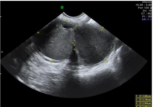 Gambar 3.8 Gambar USG menunjukkan dua endometrioma bilateral