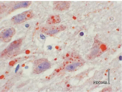 Gambar 3.  Negri Body dalam area intra sitoplasmik sel neuron, berwarna merah kecoklatan, dalam  berbagai bentuk dan ukuran