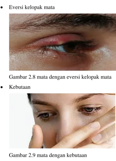 Gambar 2.8 mata dengan eversi kelopak mata 