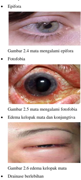 Gambar 2.4 mata mengalami epifora 