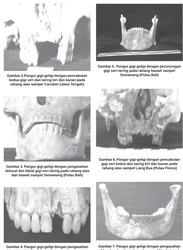 Gambar 6. Pangur gigi-geligi dengan pencabutan gigi seri kedua dan taring kiri dan kanan pada