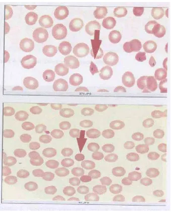 Gambar 3. Schistocytes  dan Spherocytes (Dikutip dari W e inste in  7)  