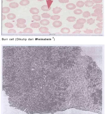 Gambar 4. Burr cell (Dikutip dari   