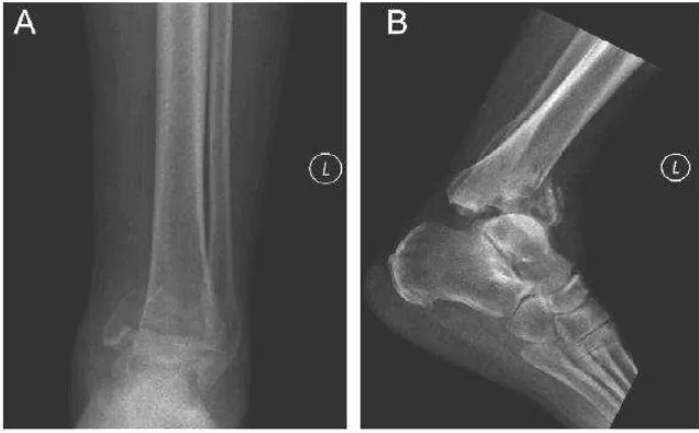 Gambar 2.7 Foto polos anteroposterior dan lateral pergelangan kaki kiri menunjukkan fraktur pilon komplit tertutup, kominutif, dengan hilangnya kortek tulang anterior dan dislokasi talus