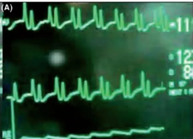 Gambar 2.4 EKG intraatrial yang menunjukan gelombang P atrial ( Gelombang P  yang lebih besar dari gelombang R) ( Joshi, 2008) 