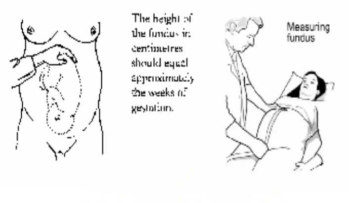Gambar 4. Pengukuran tinggi fundus uteri dengan menggunakan sentimeter.           