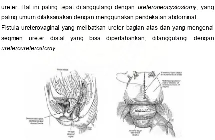 Gambar 11. Fistelplastik fistula vesikovaginal transabdominal 