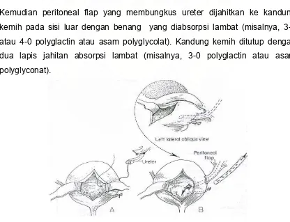 Gambar 12. Ureteroneocystostomy