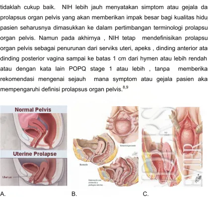 Gambar 2.  Prolapsus Organ Pelvis . 