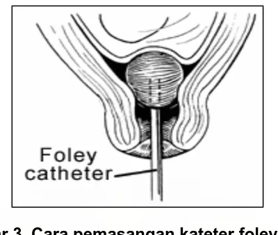 Gambar 3. Cara pemasangan kateter foley (dikutip dari 35) 
