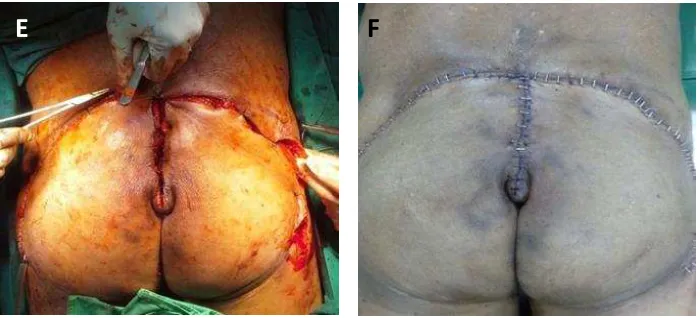 Figure A. Patient. SCC of the sacrum in a 65-year-old male patient. B. Resultant sacral defectmeasuring 9 by 12 cm