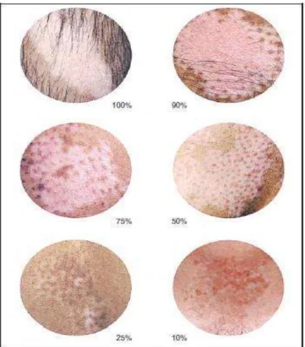 Gambar    2.1    Derajat  depigmentasi  VASI.  Panduan  yang    telah      distandarisasi    untuk  memperkirakan  derajat  pigmentasi  pada  vitiligo (dikutip dari kepustakaan no.50) 