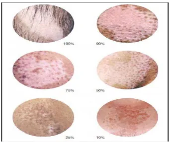 Gambar 2.1. Panduan untuk memperkirakan derajat pigmentasi pada vitiligo  (Hamzavi dkk., 2004) 